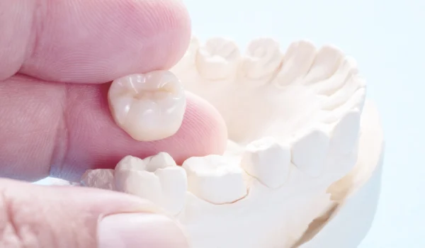 Everything You Need to Know About Dental Crowns